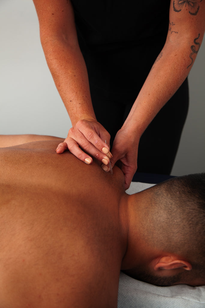 Professional acupuncture treatment in Auckland at RehabCo Physio, promoting pain relief, injury recovery, and holistic well-being