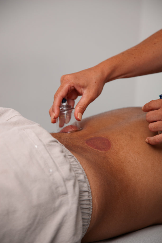 Cupping therapy session at RehabCo Physio to alleviate muscle tension